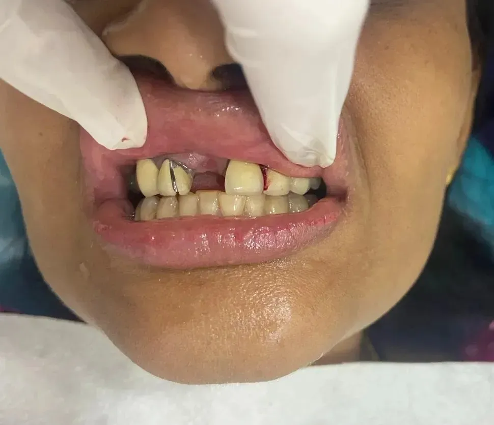 Missing Teeth Before Dental Implant Treatment